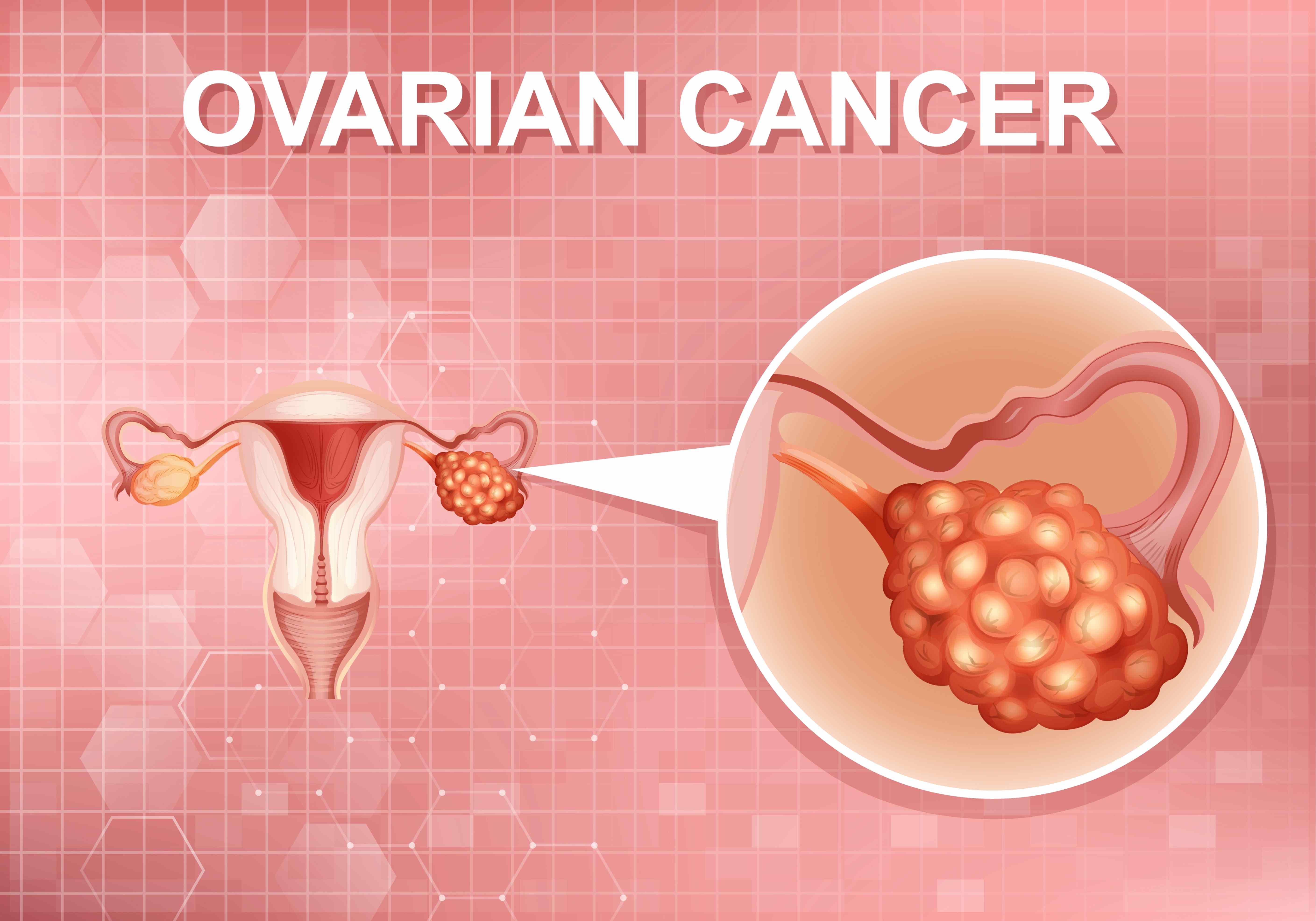 Ovarian Cancer and Postpartum Haemorrhage, Understanding an Overlooked Maternal Health Risk