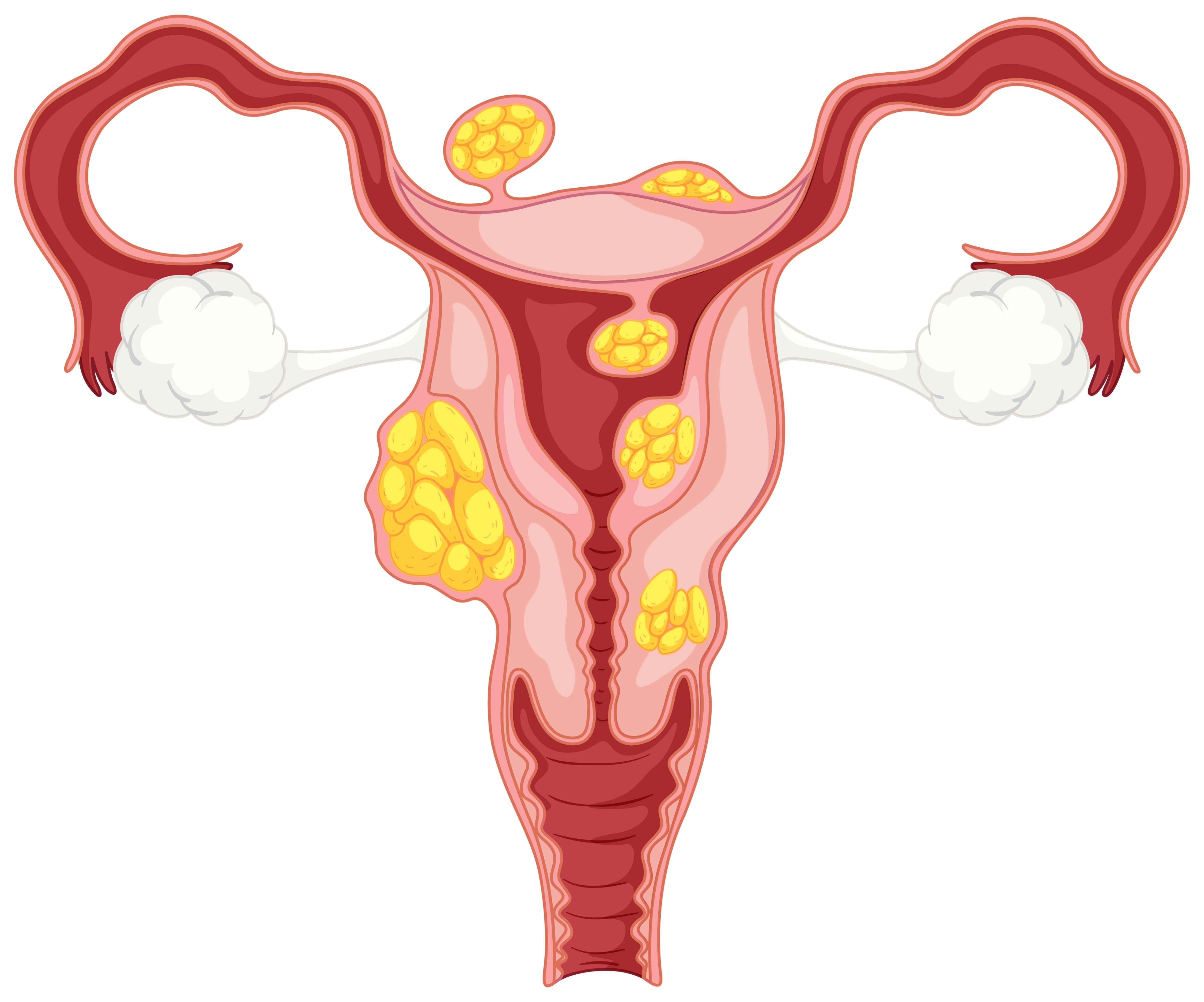 When Fibroids Increase the Risk of PPH; Understanding the Link Between Fibroids, Uterine Atony and Postpartum Haemorrhage